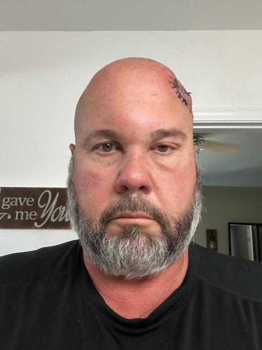 The sweilling 4 days post op.